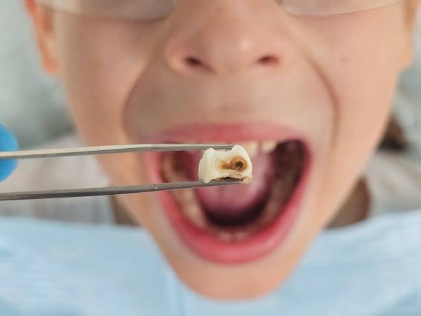 Best Emergency Treatment for Dental Infections or Abscesses in Las Campanas, NM